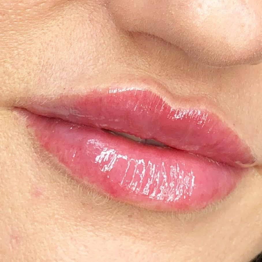 Powiększone usta z błyszczącym, różowym wypełniaczem, widoczne drobne zmarszczki wokół ust i lekko zaczerwieniona skóra.