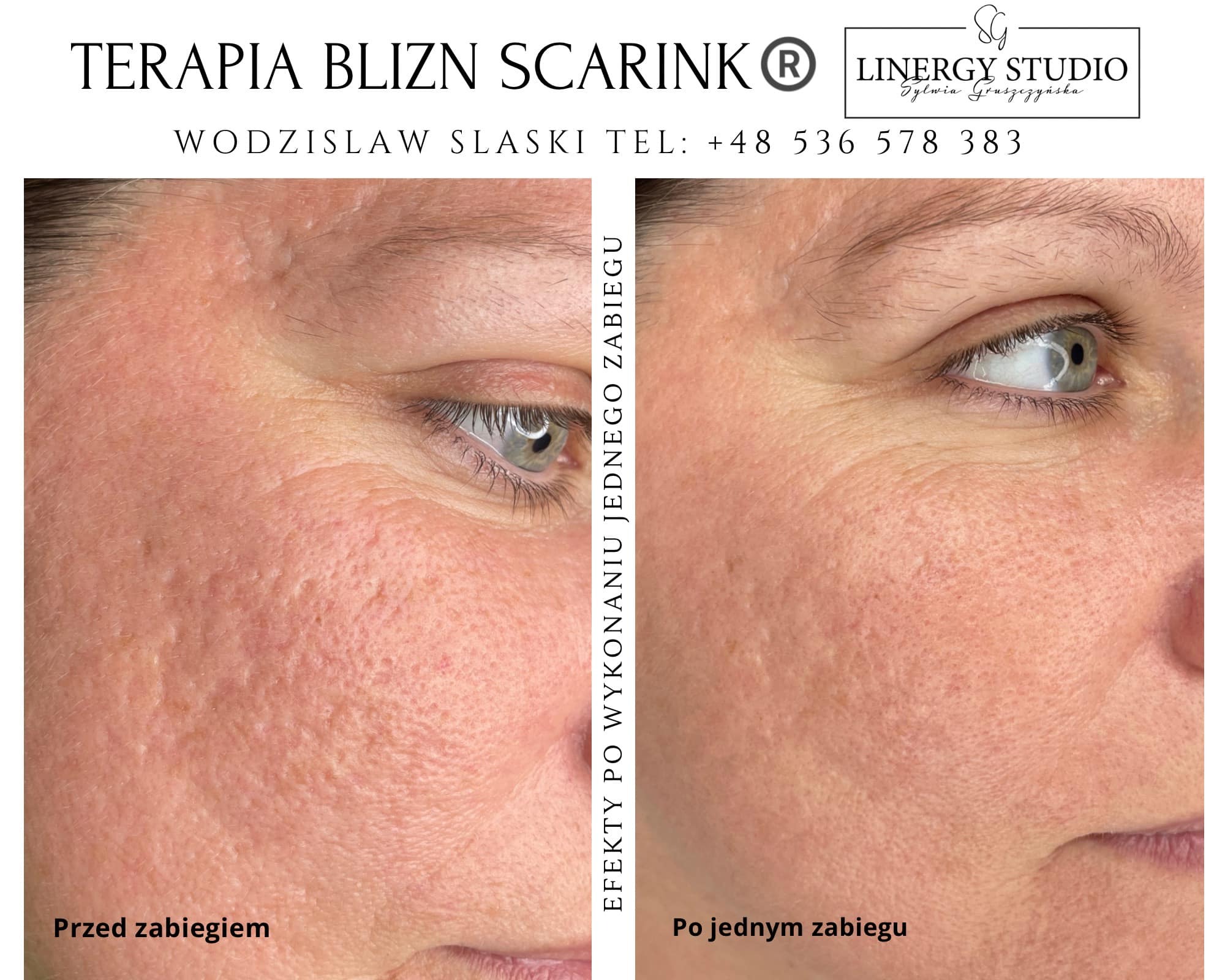 Porównanie skóry twarzy przed i po jednym zabiegu terapii blizn, widoczne zmniejszenie nierówności i poprawa tekstury skóry wokół oka.