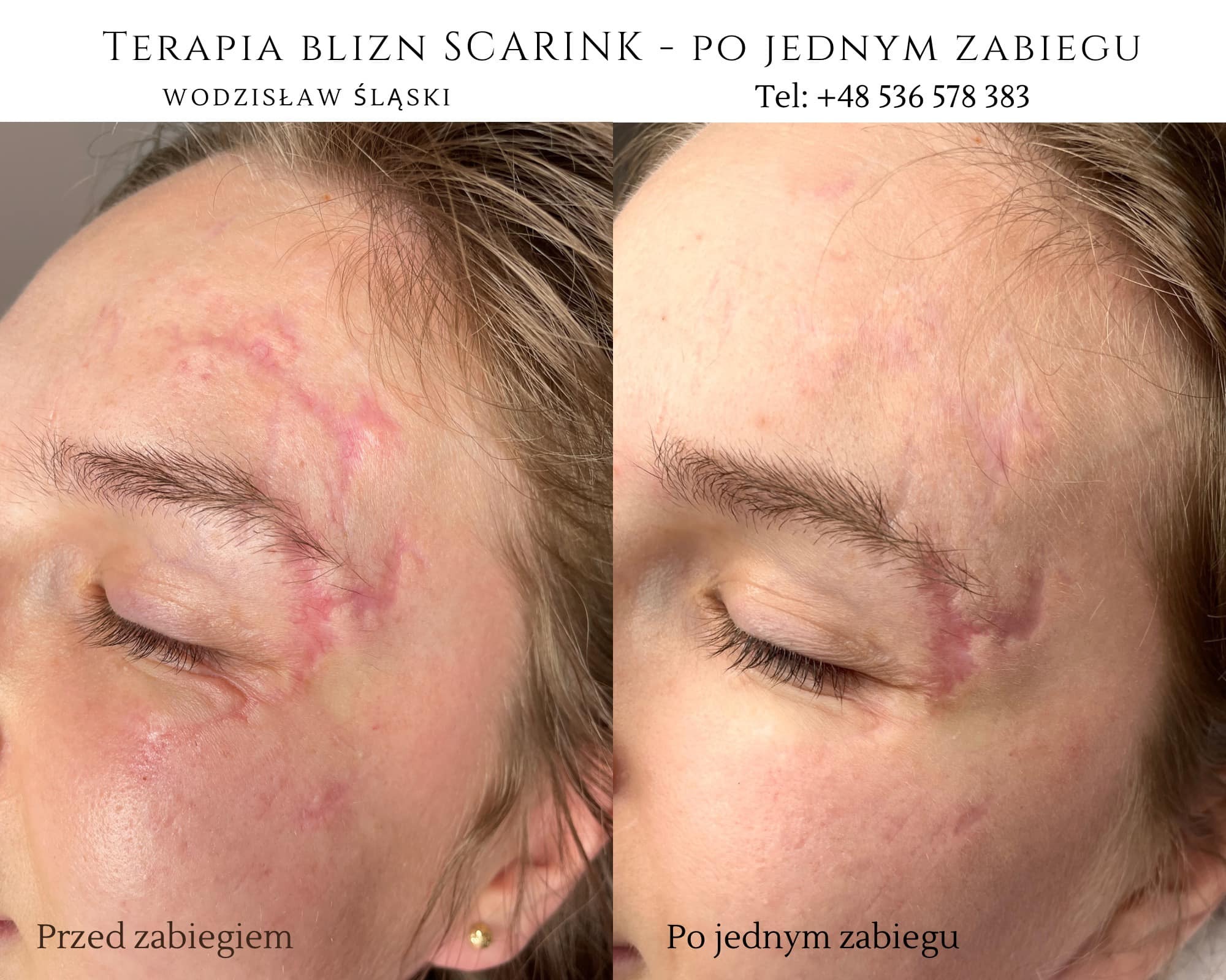 Zdjęcie porównawcze twarzy przed i po jednym zabiegu terapii blizn w Wodzisławiu Śląskim, ukazujące redukcję widoczności blizn na czole i skroni.