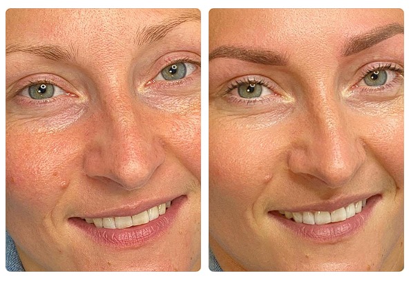 Zbliżenie twarzy kobiety przed i po zabiegu mikropigmentacji brwi; widoczne różnice w kształcie i kolorze brwi, z uwzględnieniem naturalnego odcienia skóry i uśmiechu.