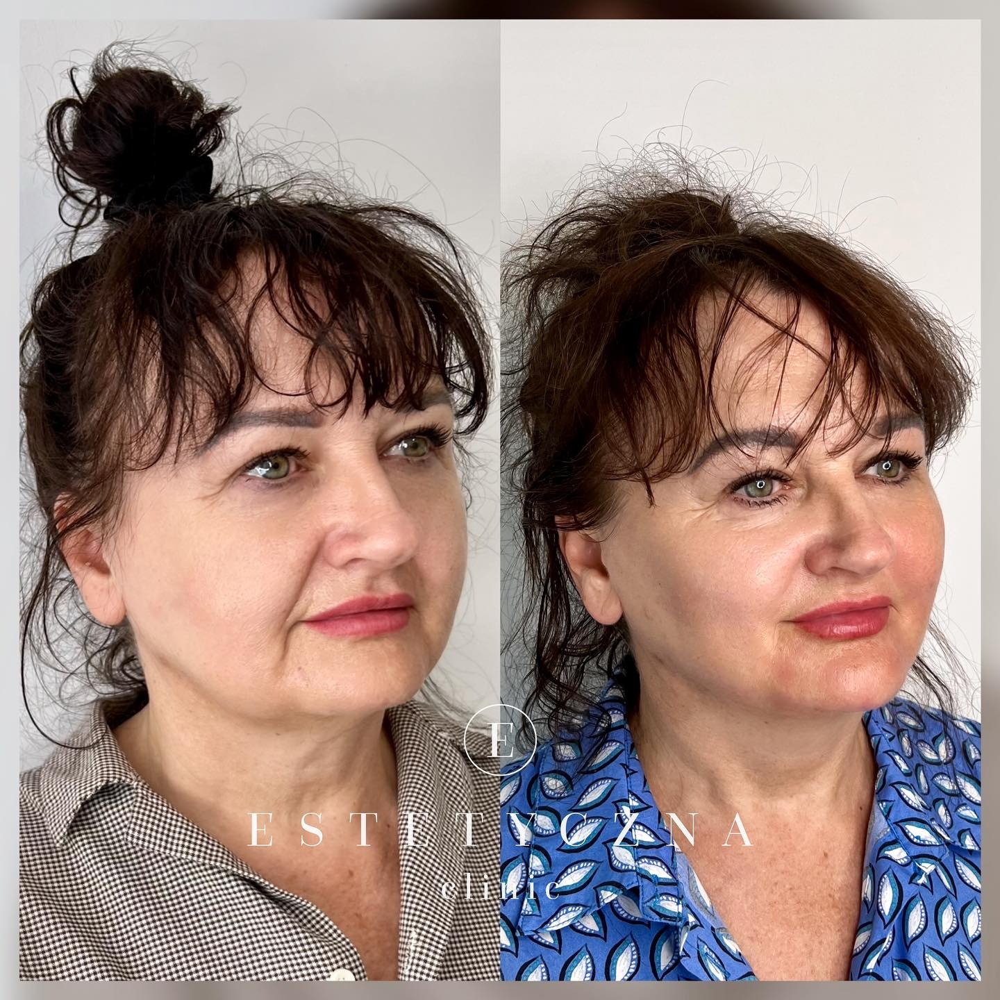 Kobieta przed i po zabiegu poprawiającym wygląd skóry szyi i owalu twarzy, widoczne subtelne zmiany w napięciu skóry i redukcji zmarszczek.