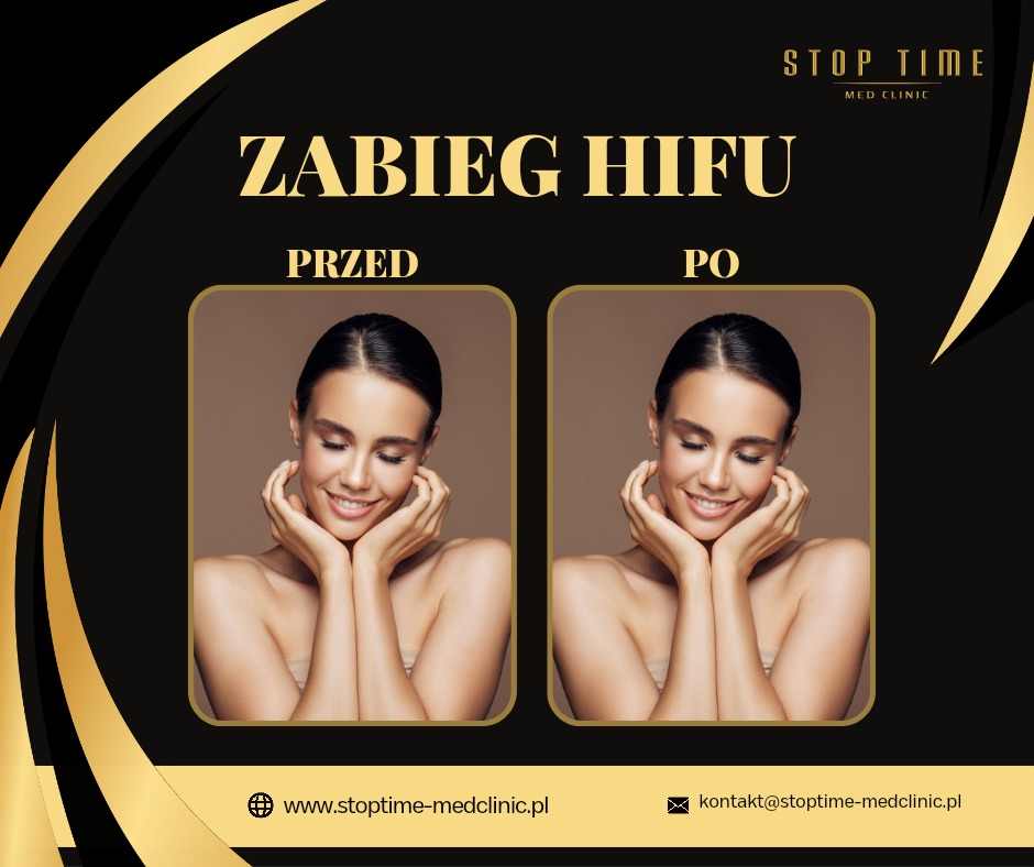 Zdjęcie typu 'przed i po' prezentujące efekty zabiegu HIFU na twarzy młodej kobiety, z logo i danymi kontaktowymi kliniki medycyny estetycznej.