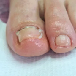 Zbliżenie na stopę z założoną klamrą na wrastający paznokieć dużego palca, widoczny również drugi palec stopy.