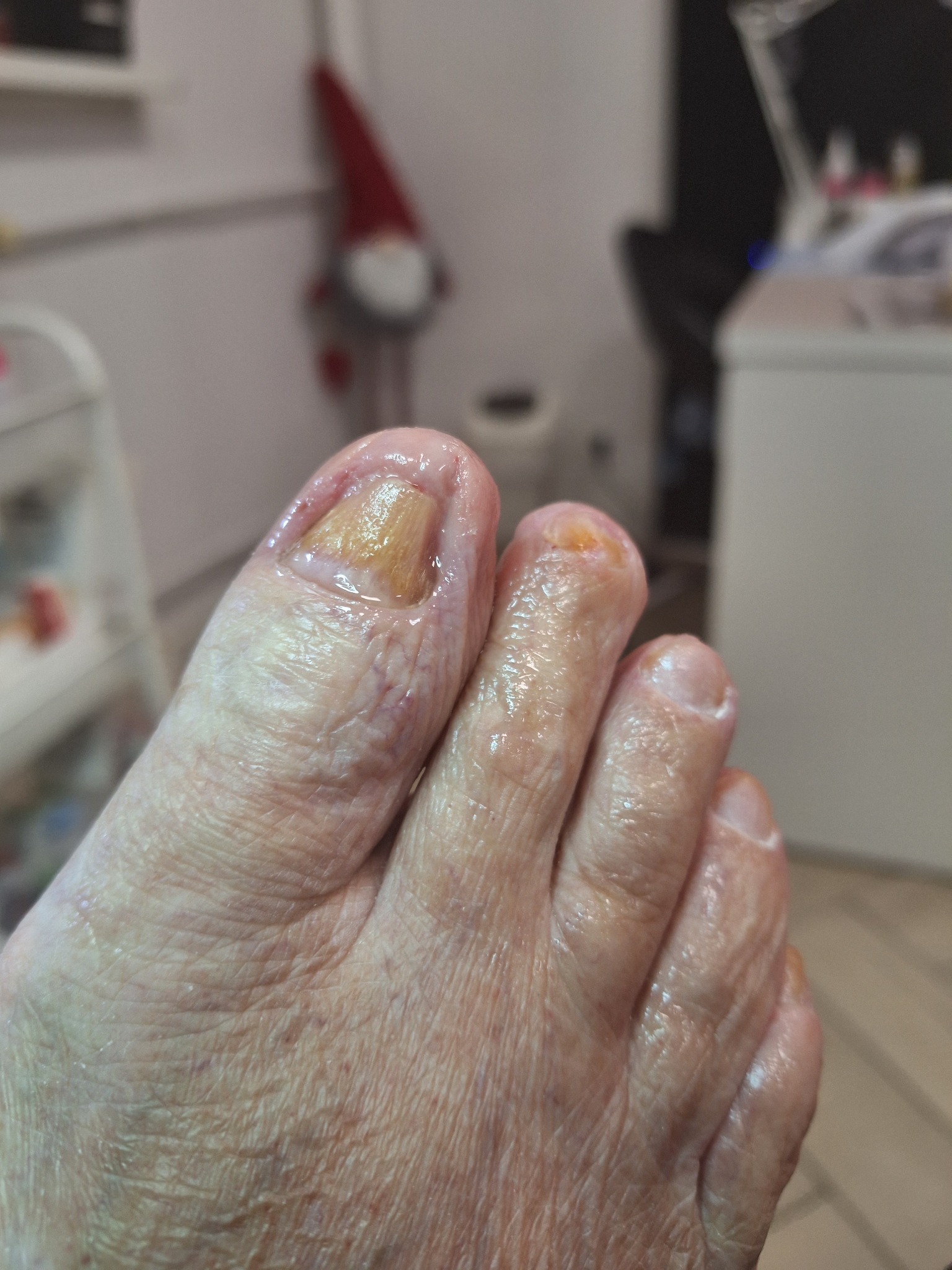 Przybliżenie stopy z widocznymi zmianami na paznokciach dużego palca i drugiego palca, potencjalnie grzybica paznokci, w tle rozmyte wyposażenie salonu kosmetycznego.