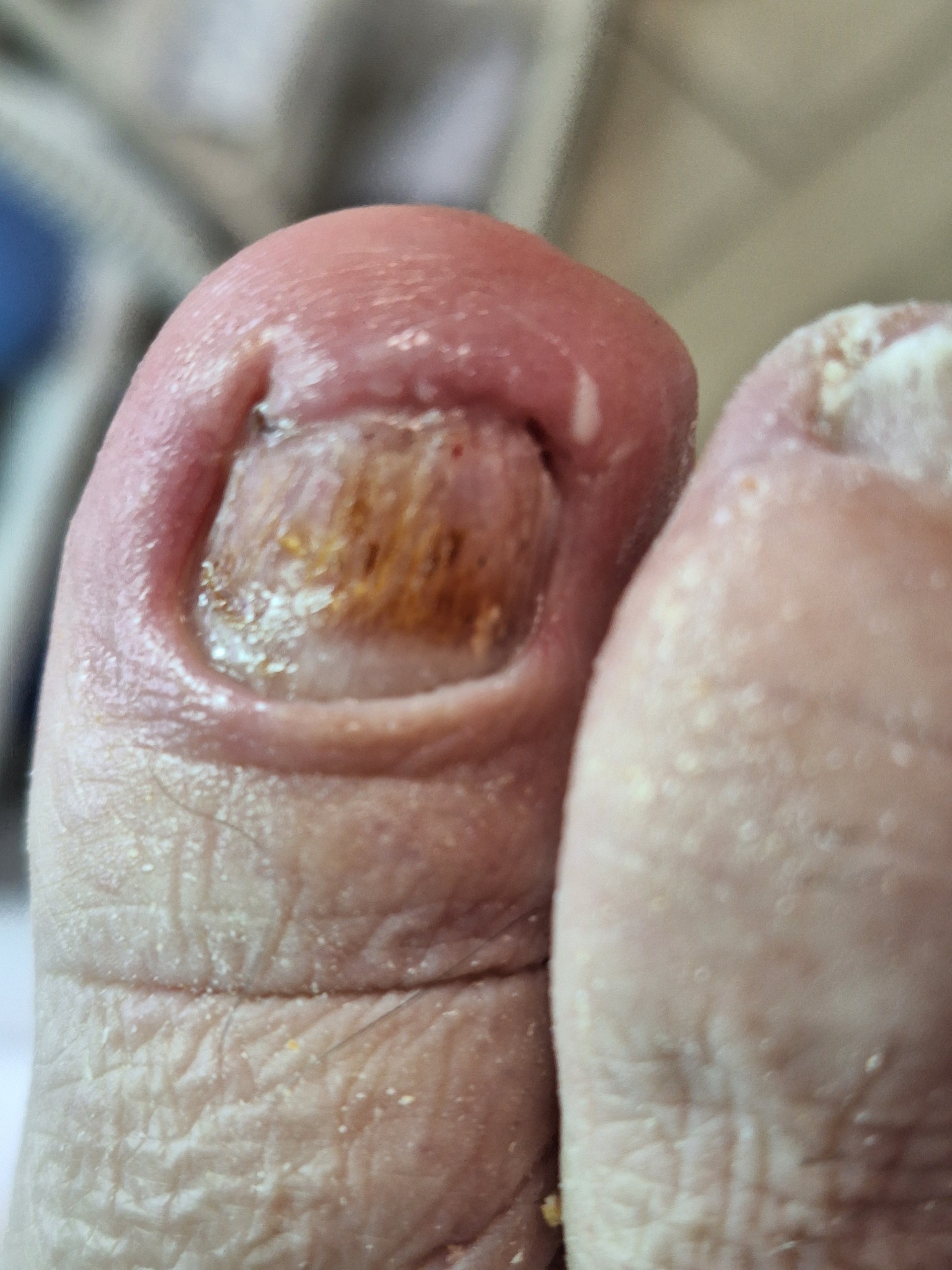 Powiększone ujęcie dużego palca u stopy z widocznymi zmianami grzybiczymi na paznokciu, jasne światło uwydatnia strukturę skóry.