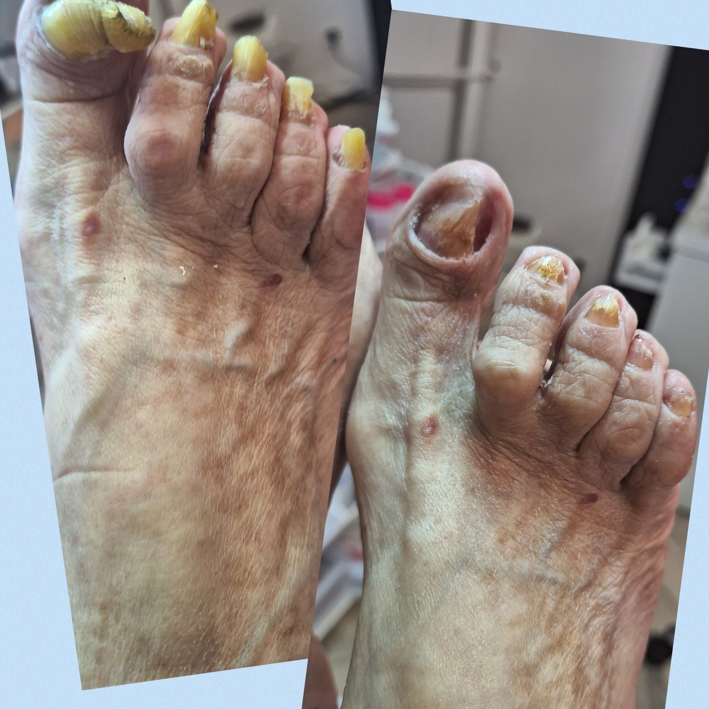 Zbliżenie na stopy z widocznymi zmianami chorobowymi paznokci i skóry, prezentowane w formacie przed i po zabiegu.