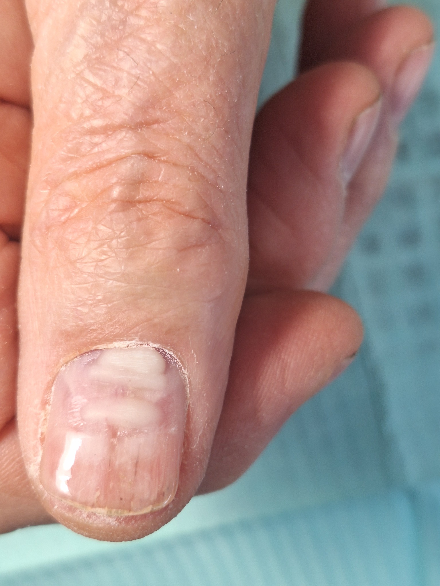 Powiększony widok palca z onycholizą, widoczne białe plamy i oddzielenie płytki paznokcia od łożyska.