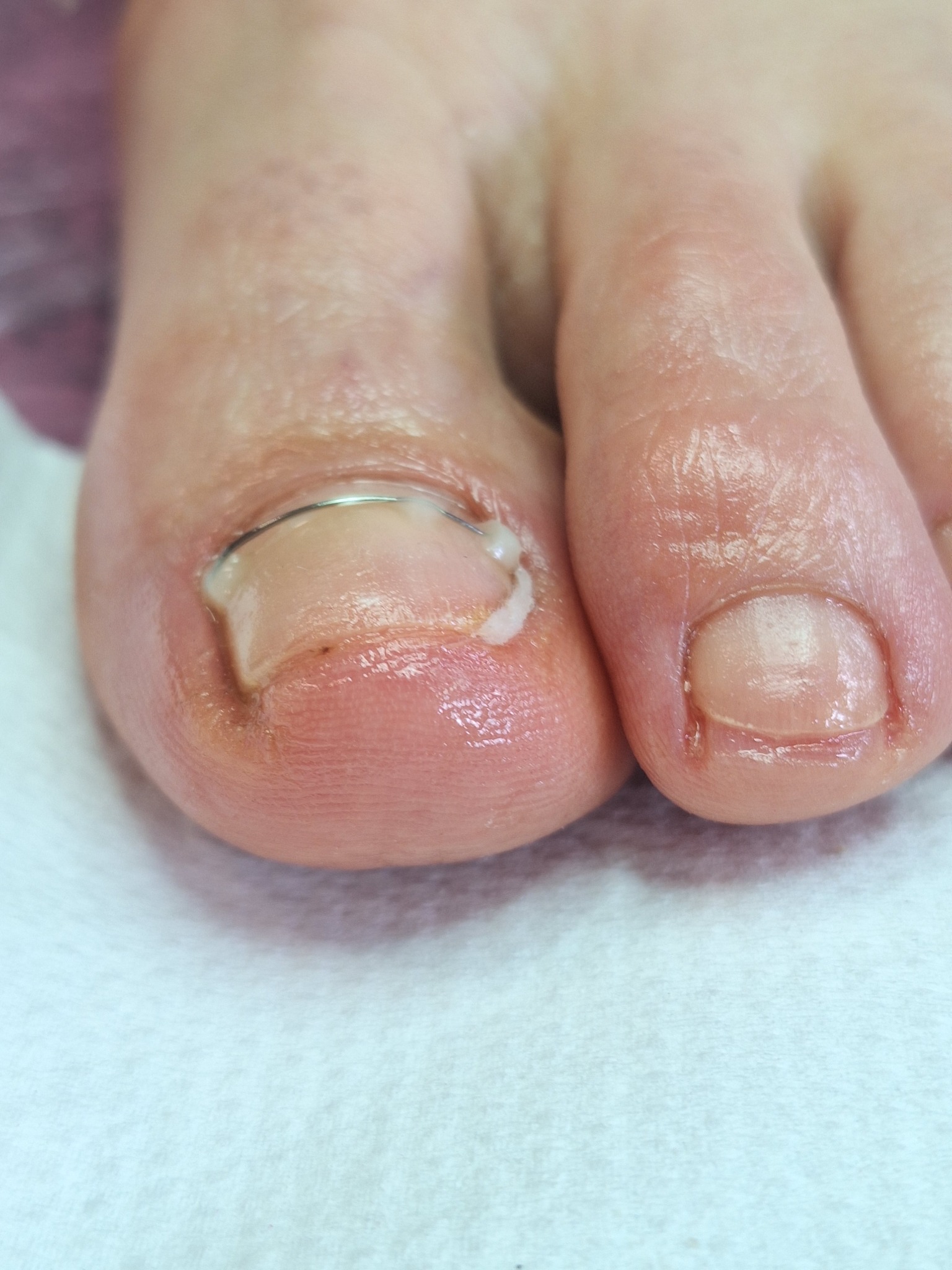 Zbliżenie na stopę z założoną klamrą na wrastający paznokieć dużego palca, widoczny również drugi palec stopy.