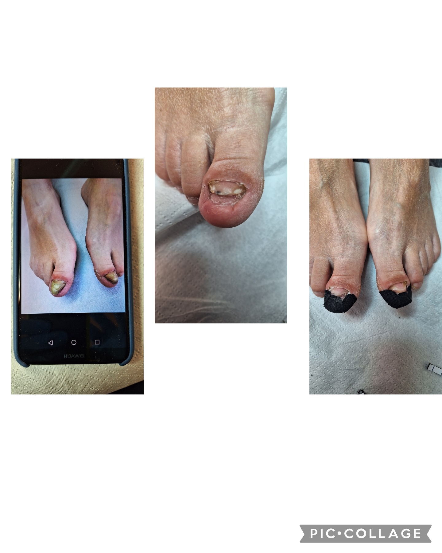 Kompozycja trzech zdjęć stóp: zbliżenie na uszkodzony paznokieć dużego palca, zdjęcie stóp z uszkodzonymi paznokciami wyświetlane na smartfonie Huawei, oraz stopy z opatrunkami na dużych palcach.