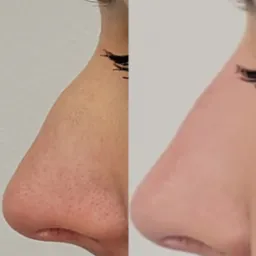 Porównanie wyglądu nosa przed i po zabiegu: po lewej widoczne rozszerzone pory i nierówności, po prawej skóra gładsza i bardziej jednolita.