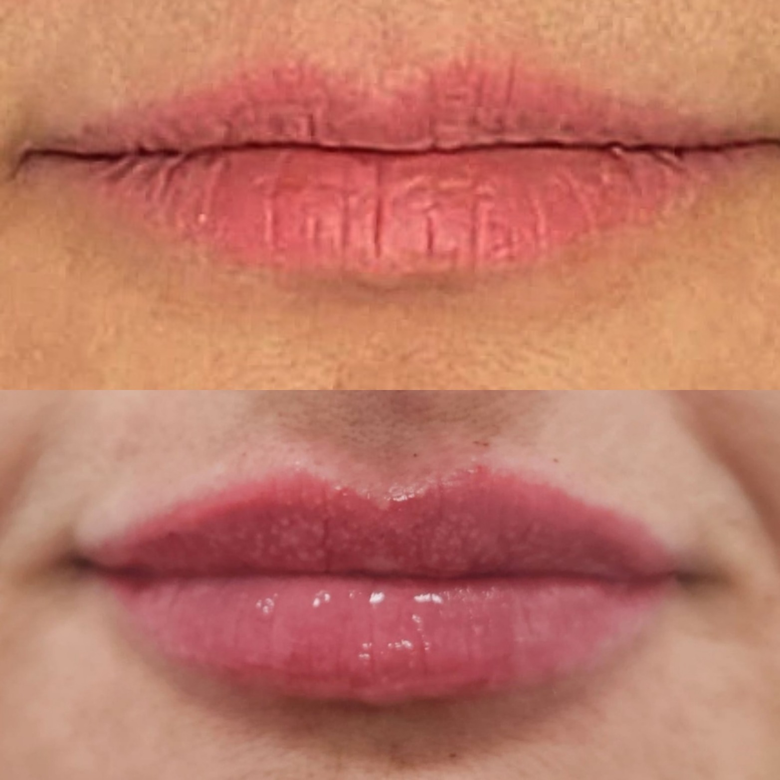 Zbliżenie na usta przed i po zabiegu powiększania, widoczne różnice w objętości i nawilżeniu.