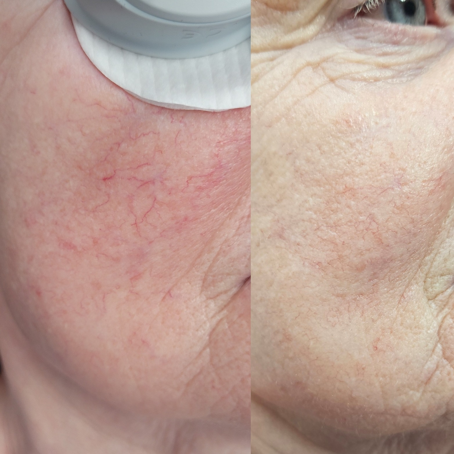 Porównanie skóry twarzy przed i po zabiegu redukcji naczynek, widoczne zaczerwienienia i pajączki przed zabiegiem oraz jaśniejsza skóra po zabiegu.