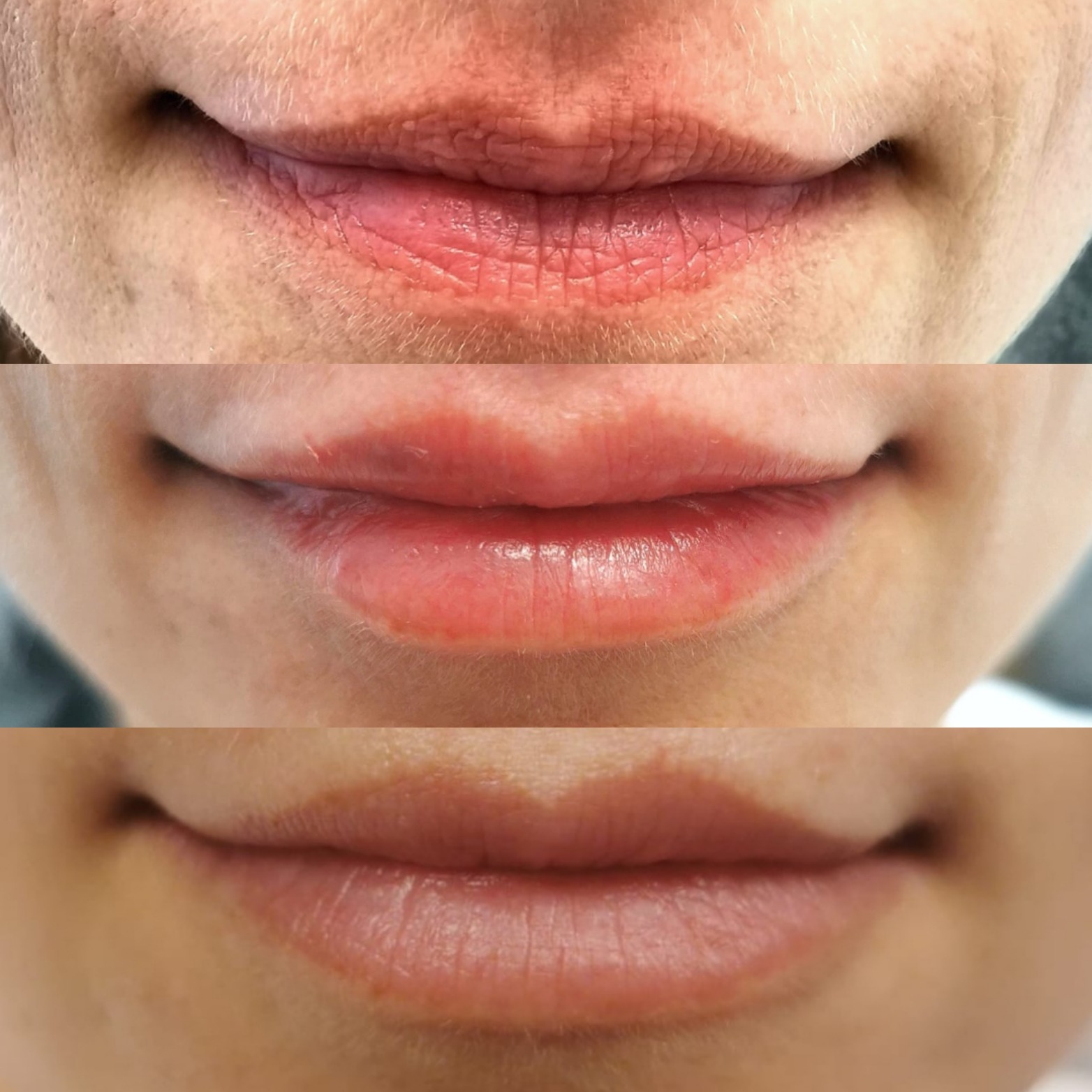 Zbliżenie na usta kobiety: przed, po i po korekcie, ukazujące zmiany w objętości i nawilżeniu, z drobnymi zmarszczkami wokół górnej wargi na zdjęciu 'przed'.