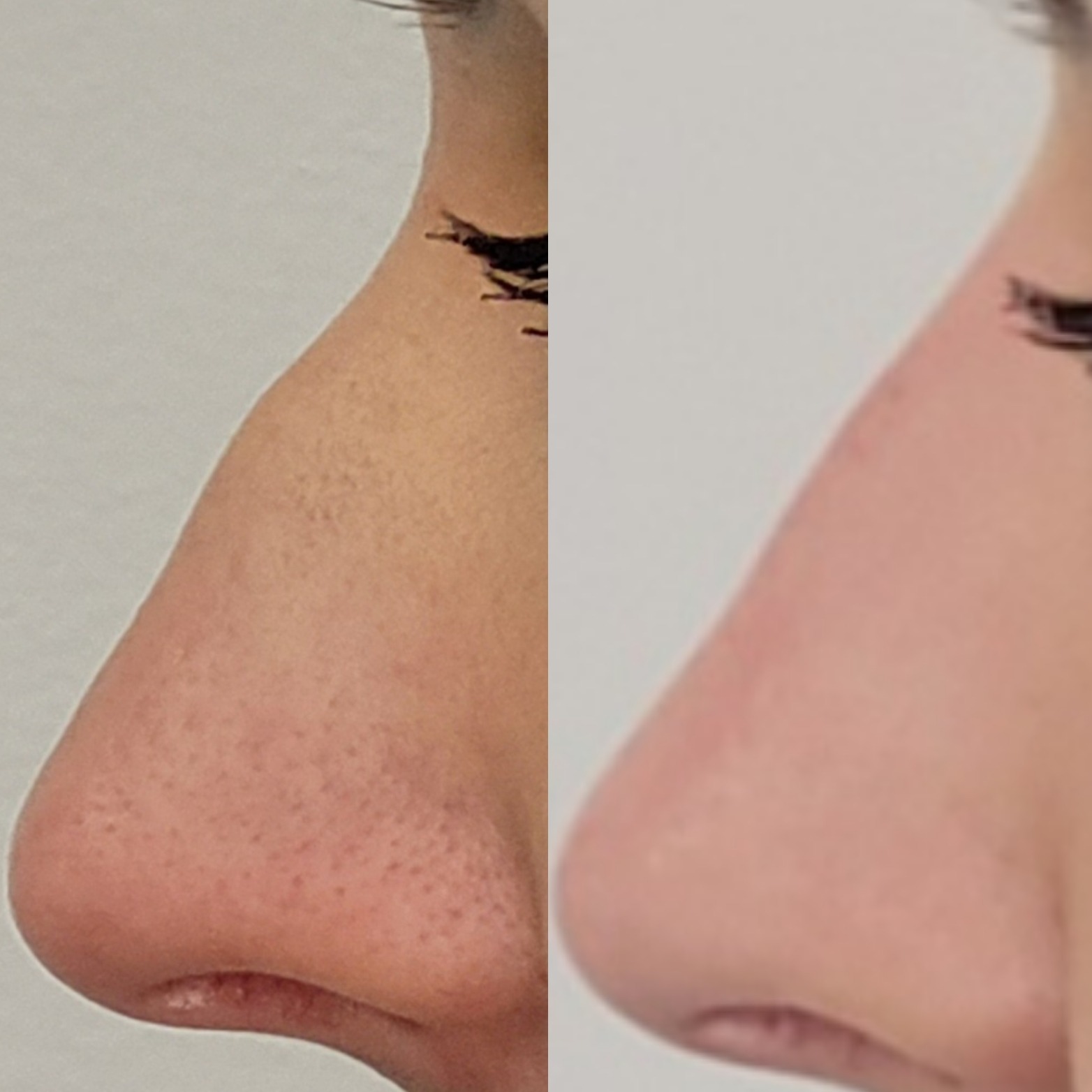 Porównanie wyglądu nosa przed i po zabiegu: po lewej widoczne rozszerzone pory i nierówności, po prawej skóra gładsza i bardziej jednolita.