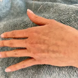 Akupunktura jest skutecznym narzędziem w walce z bólem, tu pracujemy nad bólem barku