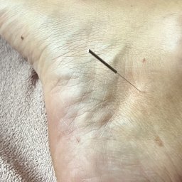 Akupunktura pomaga skutecznie usuwać objawy związane z menopauza, bezsenność, uderzenia gorząca, poty, wahania nastroju 