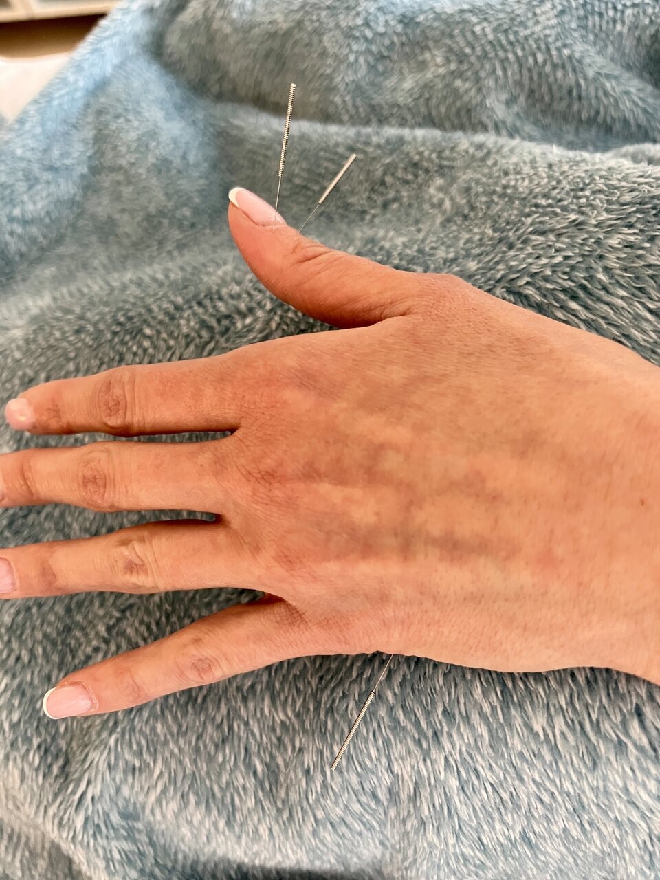 Akupunktura jest skutecznym narzędziem w walce z bólem, tu pracujemy nad bólem barku