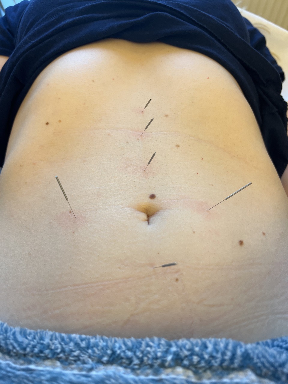 Akupunktura jest skutecznym wsparciem układu trawiennego.