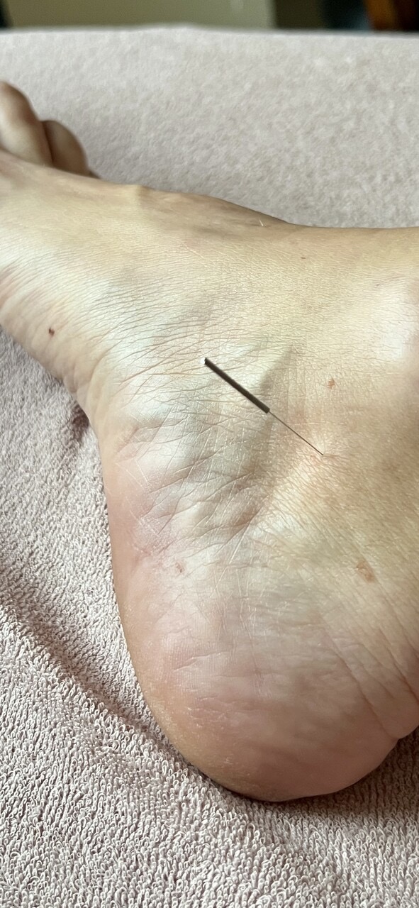 Akupunktura pomaga skutecznie usuwać objawy związane z menopauza, bezsenność, uderzenia gorząca, poty, wahania nastroju