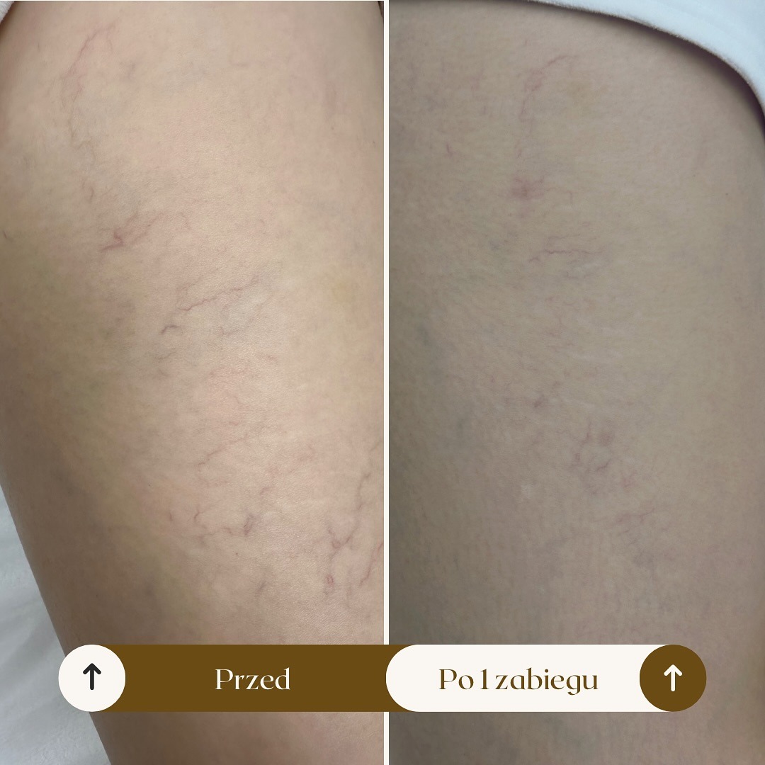 Noga przed i po zabiegu redukcji widoczności naczynek, porównanie efektów na skórze.