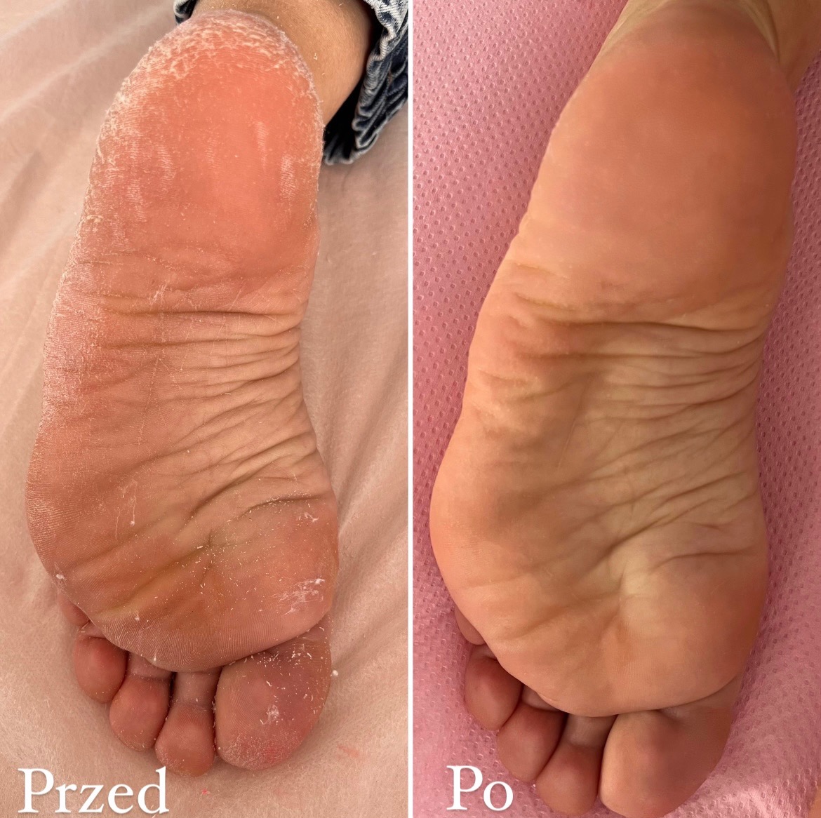 Zdjęcie stopy przed i po zabiegu pedicure, ukazujące wyraźną poprawę kondycji skóry. Lewa strona prezentuje suchą skórę z widocznymi zrogowaceniami, podczas gdy prawa strona ukazuje gładką...