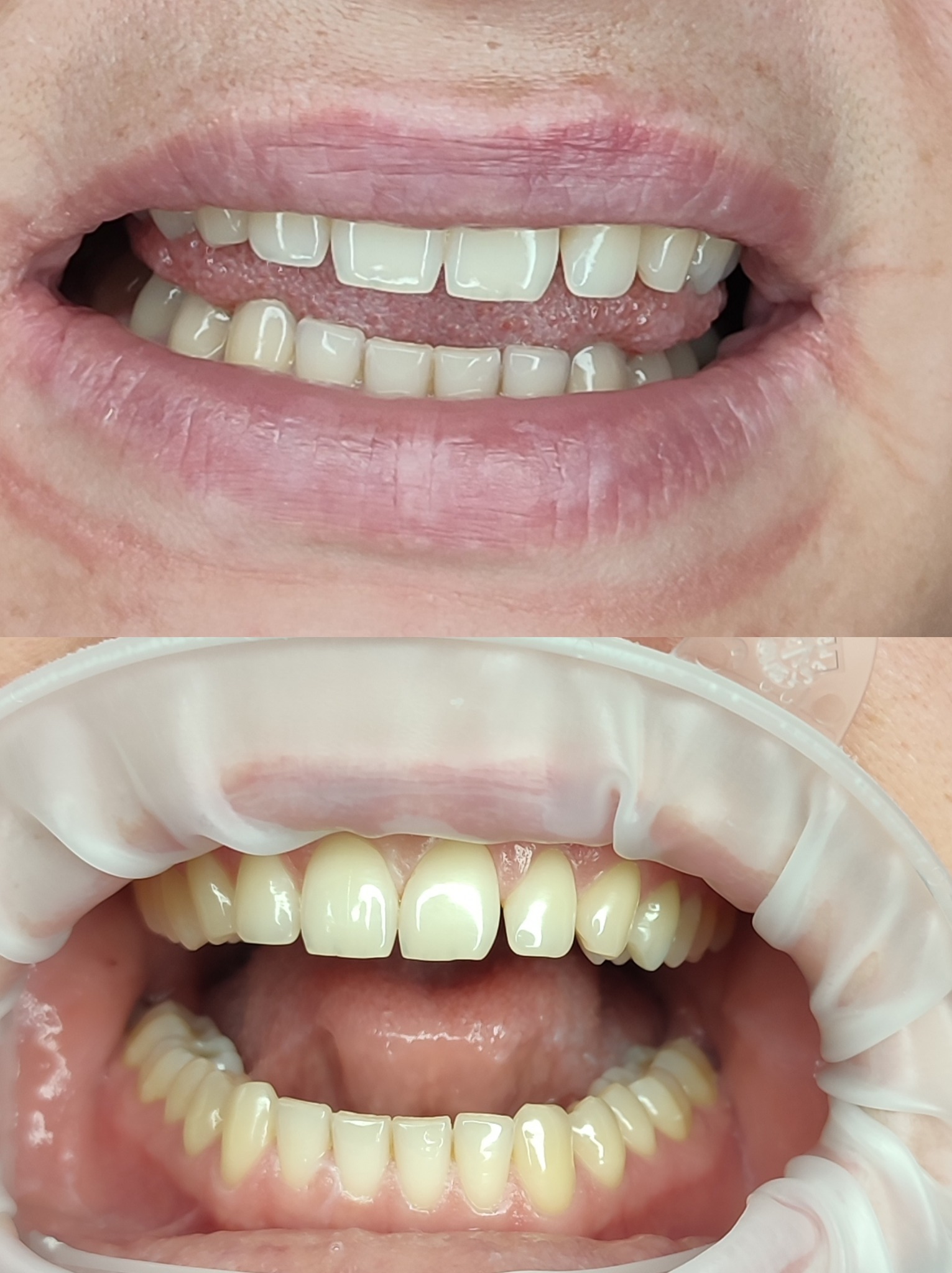 Zbliżenie na usta przed i po zabiegu stomatologicznym; górne ujęcie pokazuje naturalne zęby, dolne - zęby po założeniu licówek, z użyciem rozwieraka.