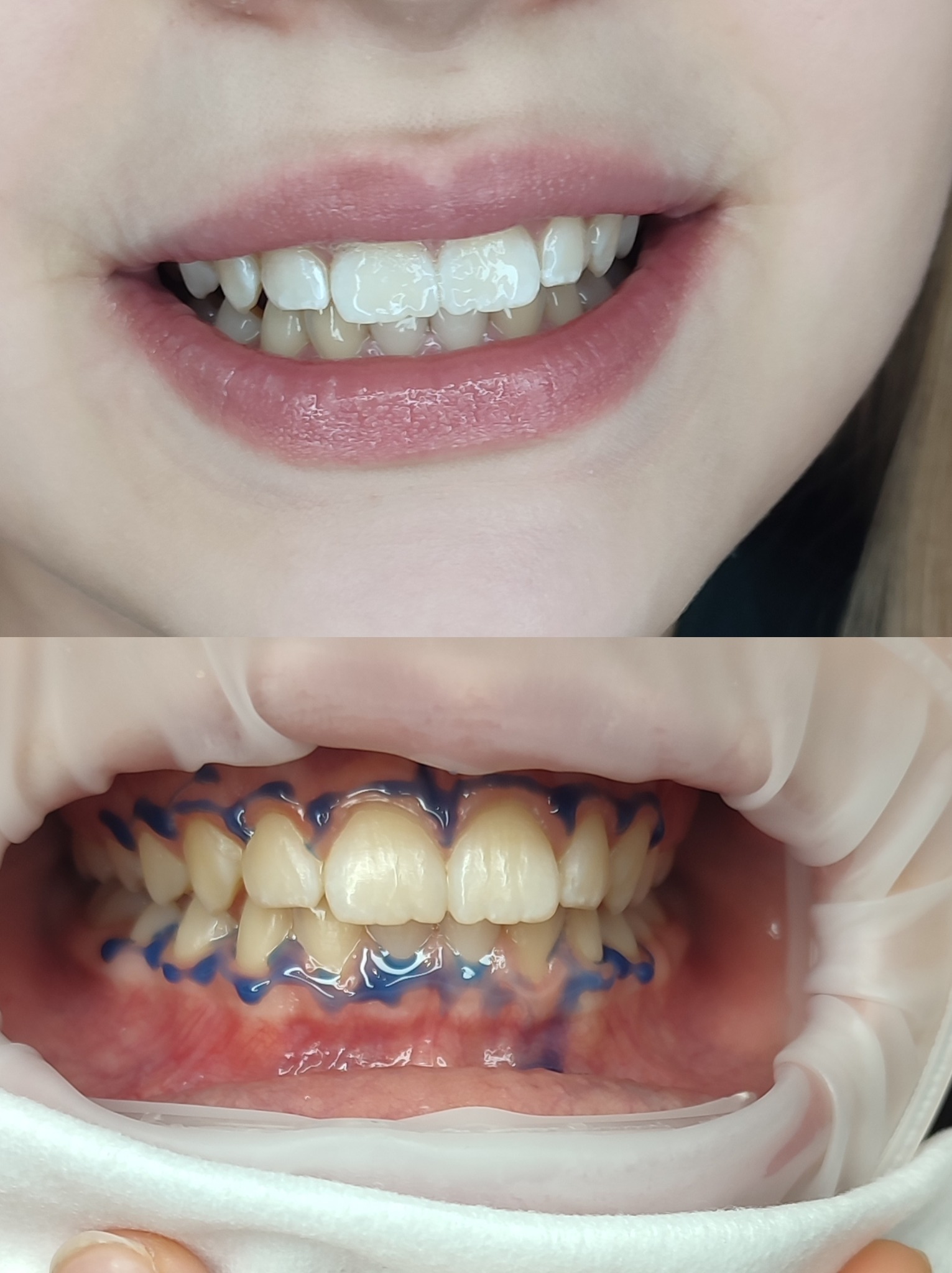 Porównanie zębów przed i po zabiegu: u góry uśmiech z widoczną nakładką wybielającą, na dole zęby z nałożonym preparatem z niebieskim barwnikiem.