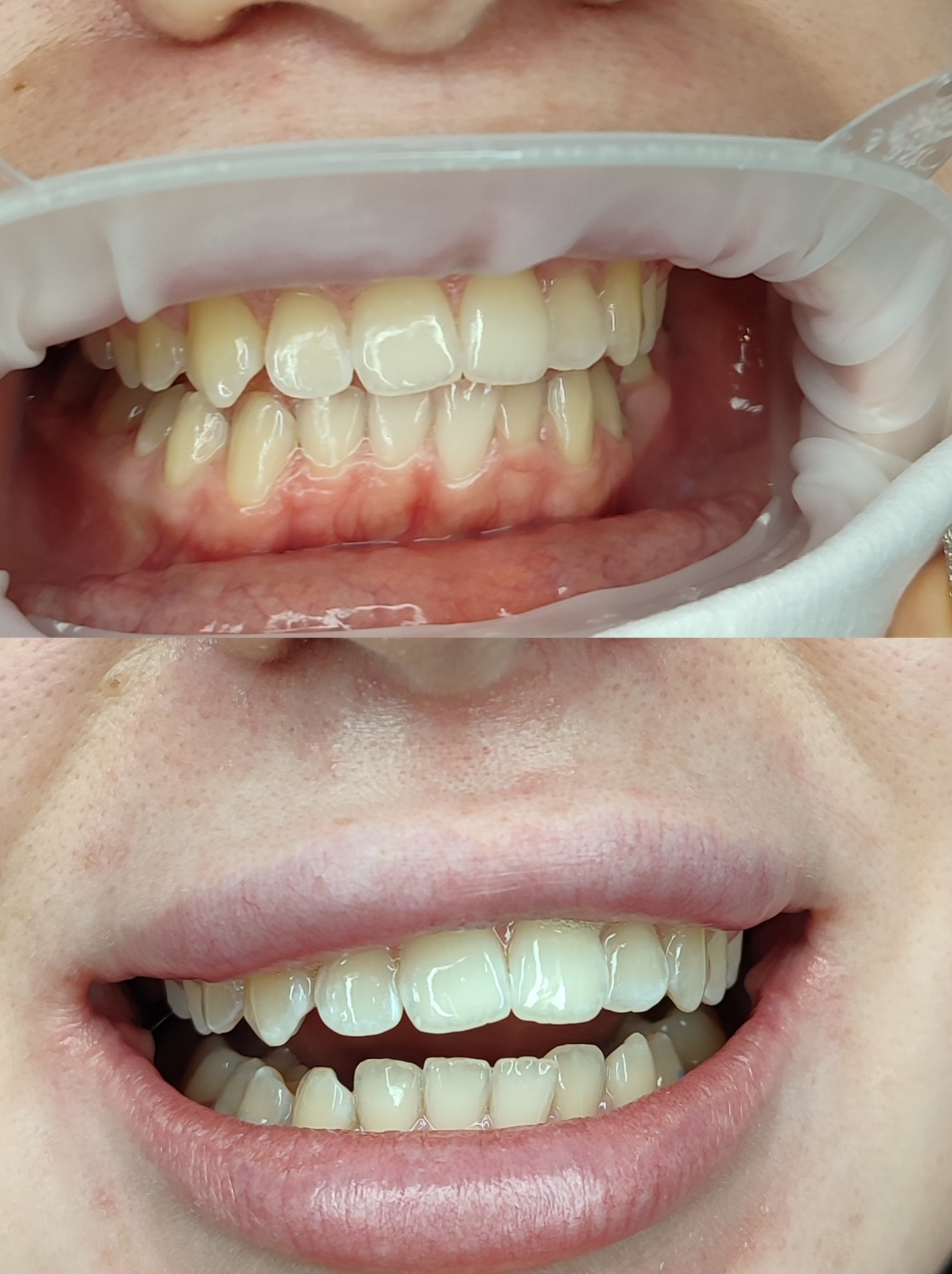 Zbliżenie na zęby pacjenta przed i po zabiegu wybielania, widoczna różnica w odcieniu szkliwa, w górnej części rozwierak w ustach.