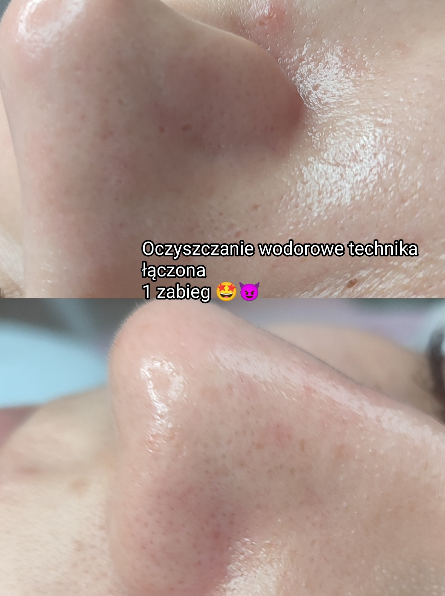 Zbliżenie na nos przed i po oczyszczaniu wodorowym, widoczne pory i zaczerwienienia skóry, porównanie tekstury skóry przed i po zabiegu.