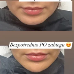 Porównanie ust przed i po zabiegu powiększania, widoczne wypełnienie i delikatny połysk, nałożony czarny ochraniacz.