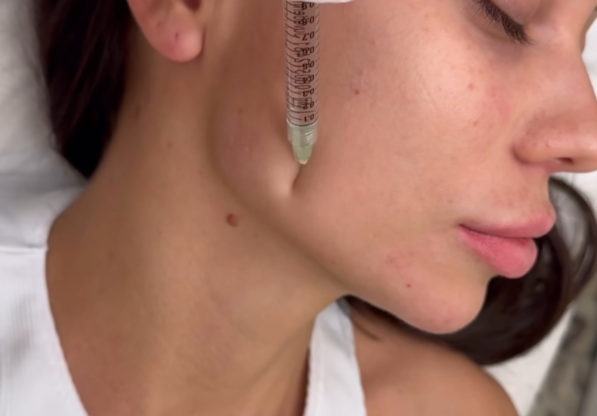 Zabieg medycyny estetycznej: wypełnianie zmarszczek u pacjentki. Widoczna igła w skórze, blisko ust. Naturalne światło, zbliżenie na twarz.