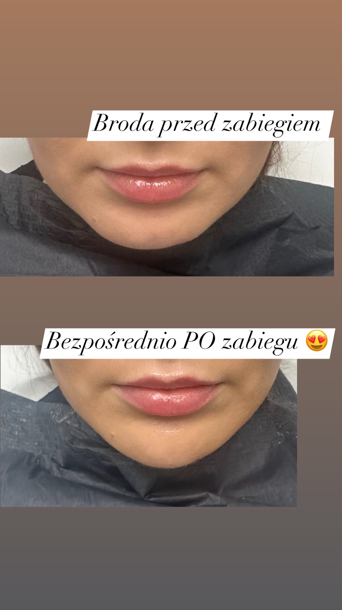 Porównanie ust przed i po zabiegu powiększania, widoczne wypełnienie i delikatny połysk, nałożony czarny ochraniacz.