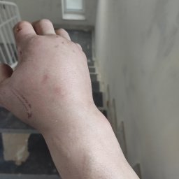 Usługi glazurnicze i remontowo budowlane JG - Opuchnięta dłoń z drobnymi ranami i zadrapaniami na tle klatki schodowej w trakcie remontu.