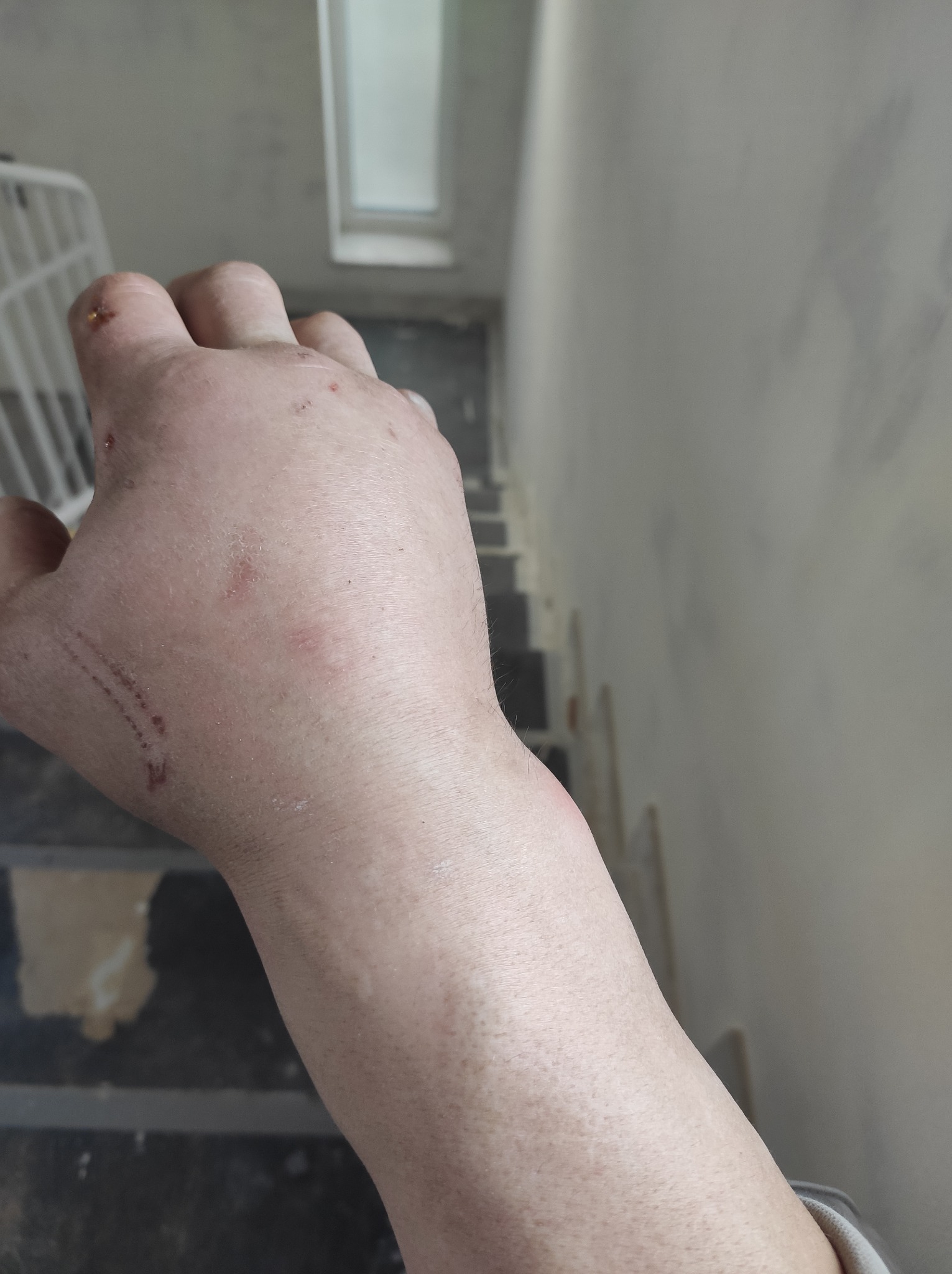Opuchnięta dłoń z drobnymi ranami i zadrapaniami na tle klatki schodowej w trakcie remontu.