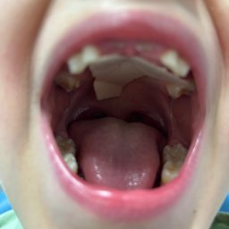 RUCH I MOWA - Szeroki kadr wnętrza jamy ustnej dziecka z widocznymi zębami, językiem i częścią gardła; w górnej części jamy ustnej widoczny kawałek gazy lub chusteczki.