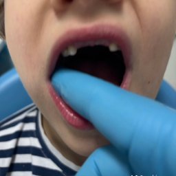 RUCH I MOWA - Otwarta buzia dziecka z brakującymi zębami, badana palcem w niebieskiej rękawiczce. Widoczne dolne i górne dziąsła oraz fragment koszulki w paski.