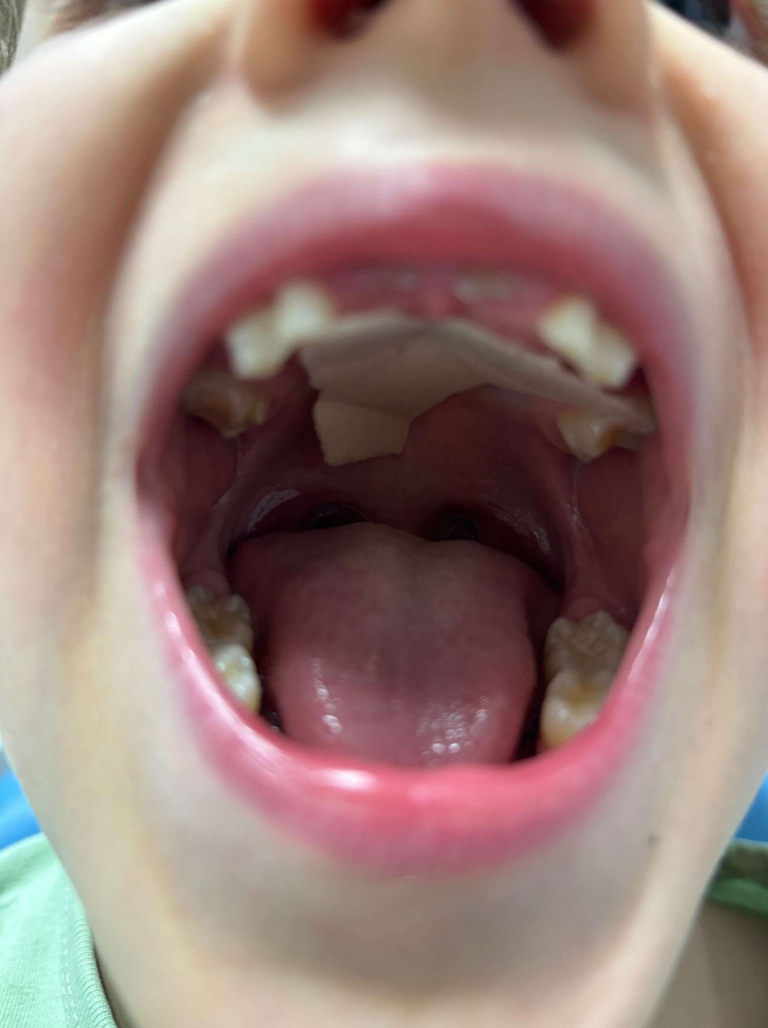 Szeroki kadr wnętrza jamy ustnej dziecka z widocznymi zębami, językiem i częścią gardła; w górnej części jamy ustnej widoczny kawałek gazy lub chusteczki.