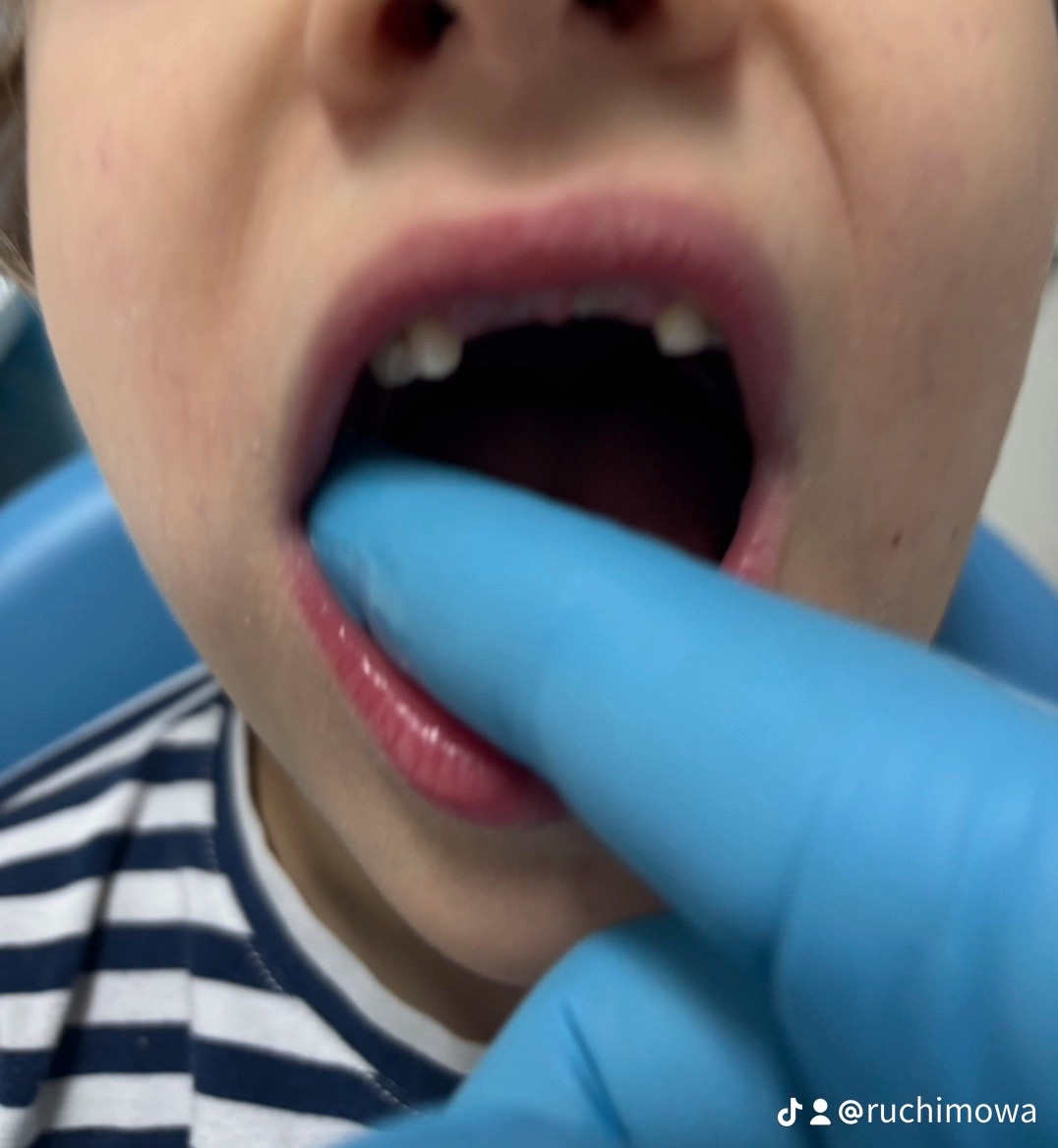 Otwarta buzia dziecka z brakującymi zębami, badana palcem w niebieskiej rękawiczce. Widoczne dolne i górne dziąsła oraz fragment koszulki w paski.