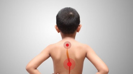 Chłopiec z zaznaczonymi punktami bólowymi kręgosłupa na plecach, widok z tyłu na jasnym tle.