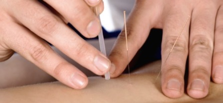 Dwie dłonie aplikują akupunkturę na skórze, widoczne cienkie igły i plastikowa prowadnica.