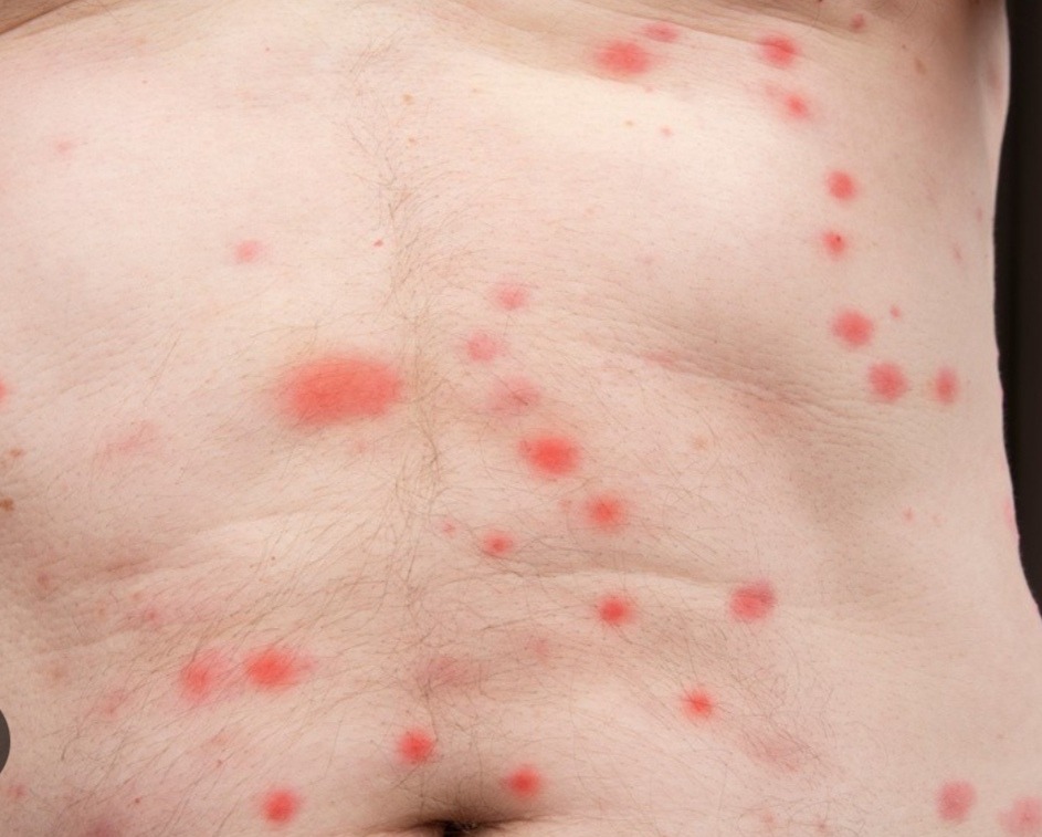 Czerwone ślady ugryzień na skórze brzucha i klatki piersiowej osoby we Wrocławiu, prawdopodobnie po ukąszeniach owadów.