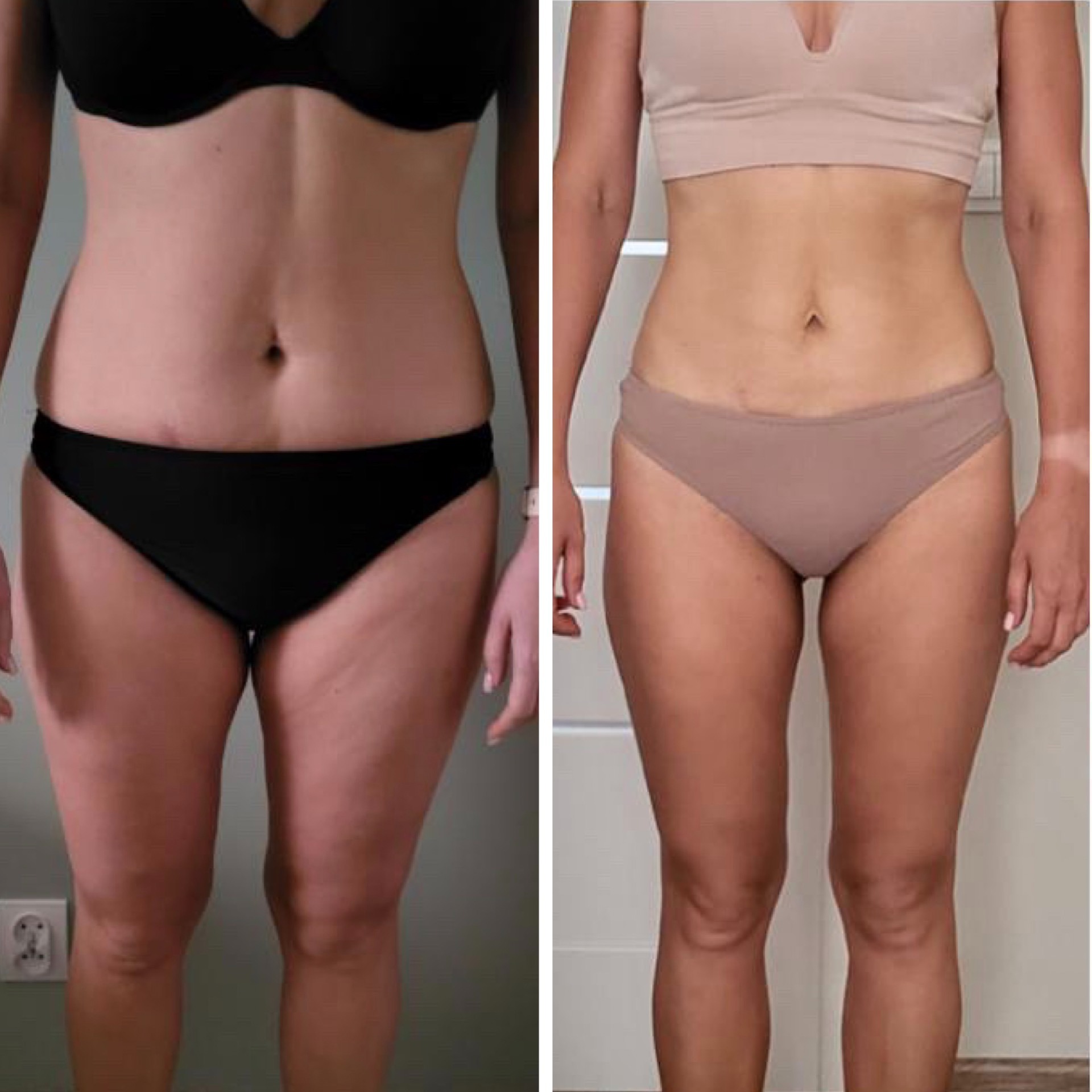 Zdjęcie typu 'przed i po' przedstawiające sylwetkę kobiety w bieliźnie, z widoczną redukcją cellulitu i poprawą jędrności skóry na udach i brzuchu.