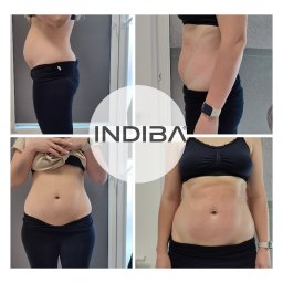 Blisko Kobiet Kartuzy - szkoła rodzenia - opieka po porodzie - zabieg Indiba - Montaż zdjęć sylwetki kobiety przed i po zabiegu, widoczne zmiany w kształcie brzucha i talii, z logo Indiba nałożonym na środek.