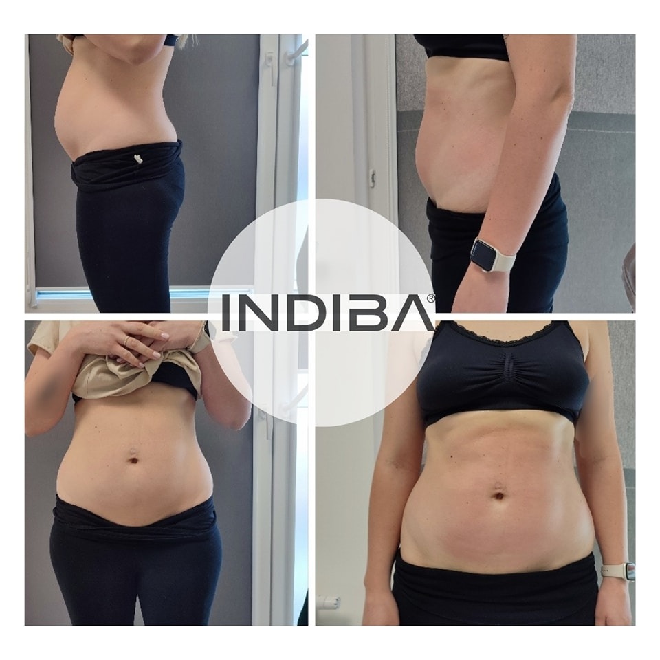 Montaż zdjęć sylwetki kobiety przed i po zabiegu, widoczne zmiany w kształcie brzucha i talii, z logo Indiba nałożonym na środek.
