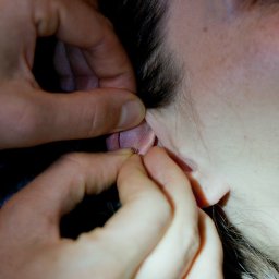 Magic Therapies Gabinet Medycyny Naturalnej - Wkładanie cienkiej igły w okolice ucha pacjentki podczas zabiegu.