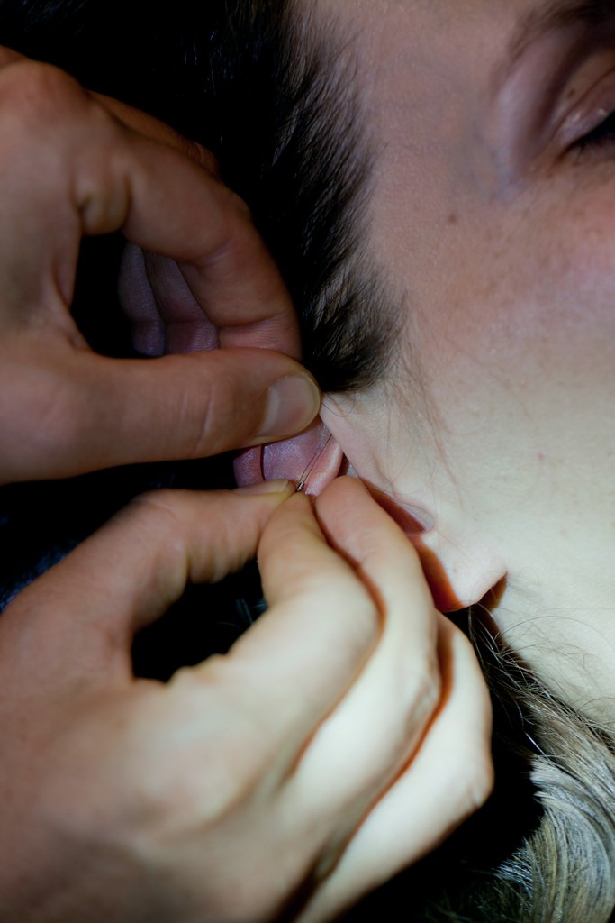 Wkładanie cienkiej igły w okolice ucha pacjentki podczas zabiegu.