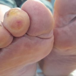 Pani z cukrzycą po zabiegu usunięcia modzeli