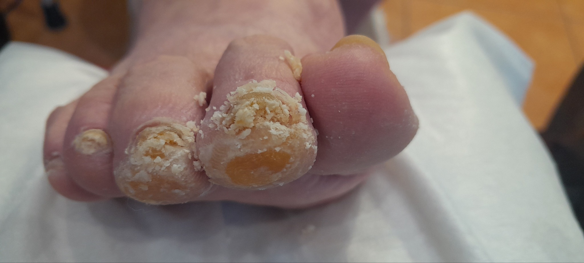 Bliskie ujęcie stopy z widocznymi zrogowaceniami na paznokciach palców, z białym, łuszczącym się naskórkiem.