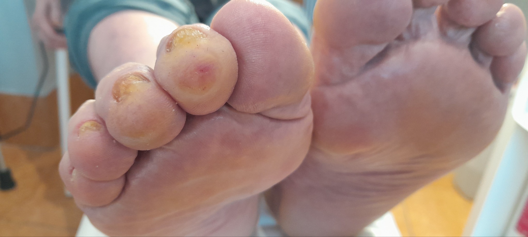 Pani z cukrzycą po zabiegu usunięcia modzeli