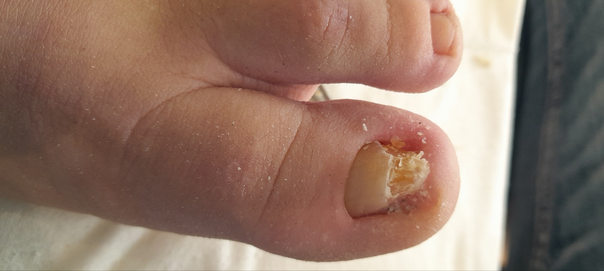 Zbliżenie stopy z widoczną onycholizą paznokcia dużego palca, ukazującą odwarstwienie płytki i nagromadzenie powietrza pod nią.